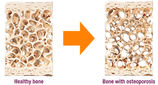 Under a microscope, healthy bone has the appearance of a honeycomb matrix. An osteoporotic bone is more porous.